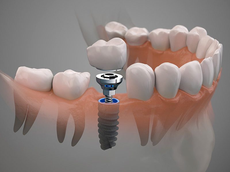 implantología dental en Donostia