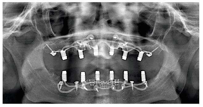 Implantes Dentales Subperi sticos En Donostia Cl nica Dental Benta 